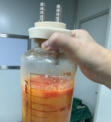 石狮水动力吸脂手术要做多久？